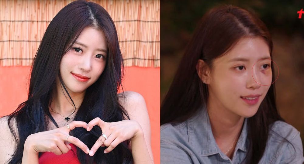 Concerns for Lovelyz's Mijoo Rises as She Made a Hospital Visit After Sustaining Eye Injury During Trip with Foreign Fan, — 'It Hurts So Much’