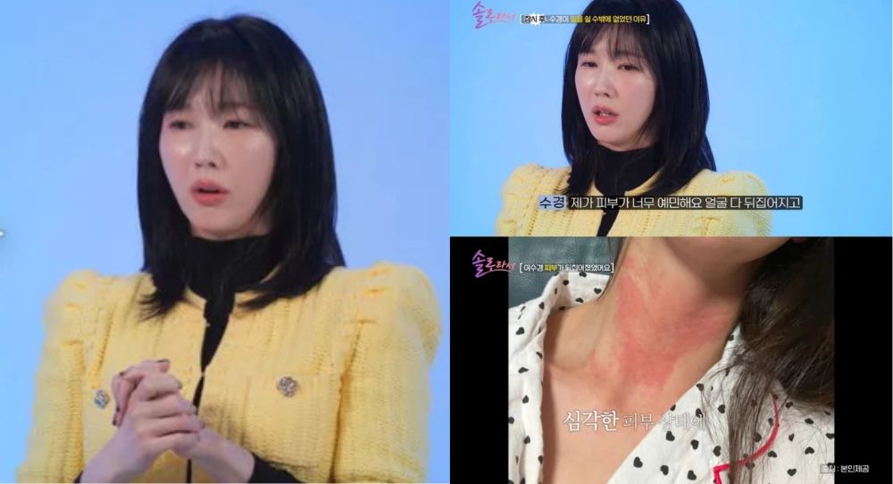 Actress Lee Soo Kyung Reveals She Almost Quit Acting due to a Mysterious Skin Condition